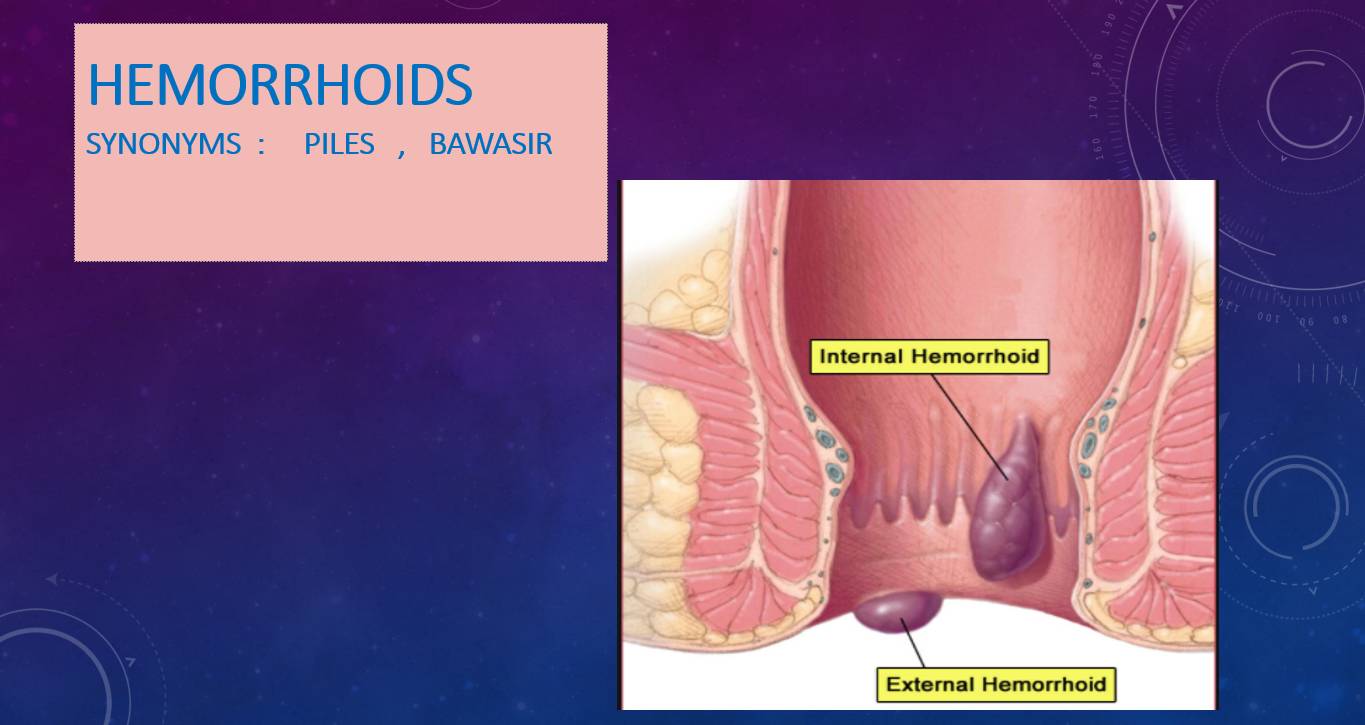Hemorrhoids
